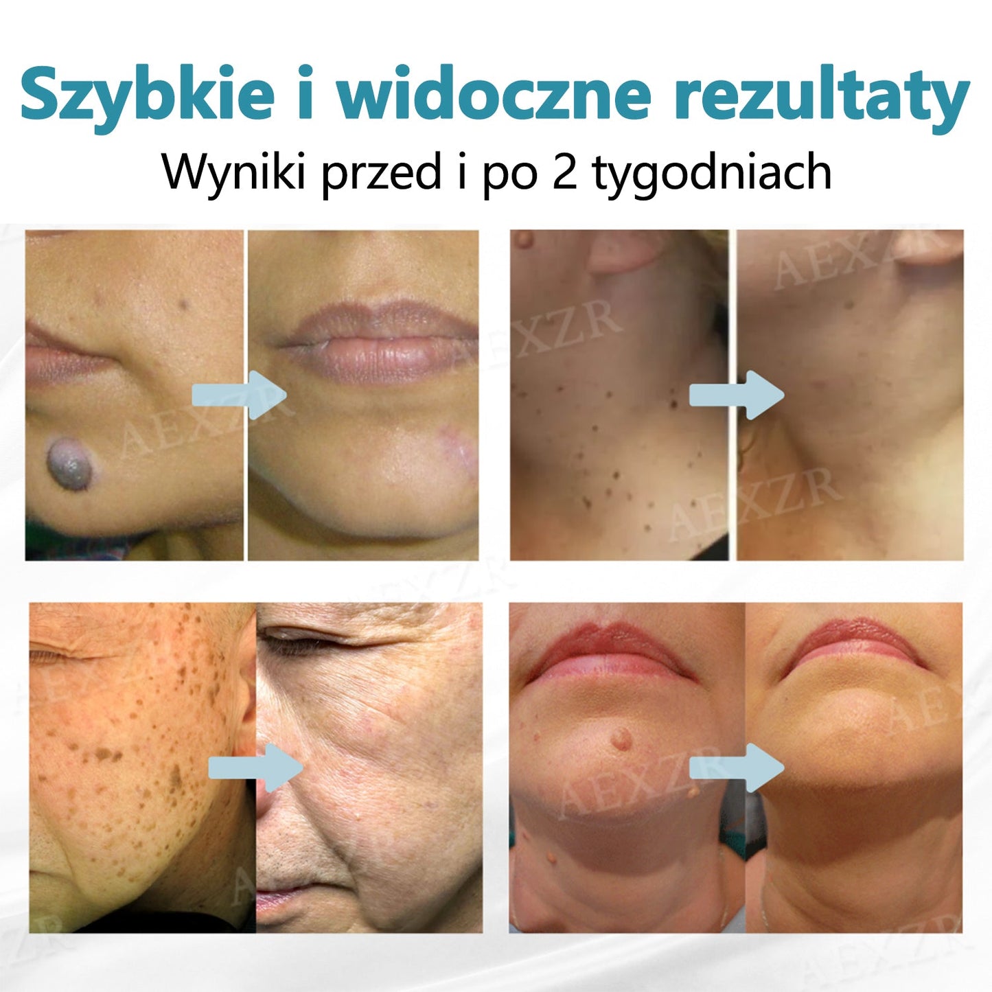 Cvreoz® nowy nieinwazyjny laser do usuwania pieprzyków i brodawek 🎉