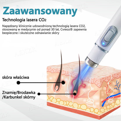 Cvreoz® nowy nieinwazyjny laser do usuwania pieprzyków i brodawek 🎉